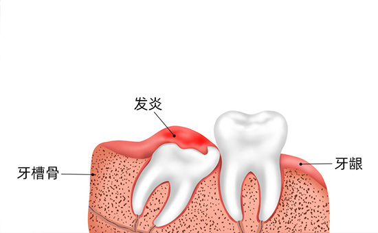 医生排行榜：南京牙齿矫正-隐适美可以戴着吃饭吗(图2)