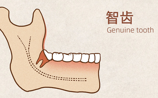 现在种牙可以用医保吗